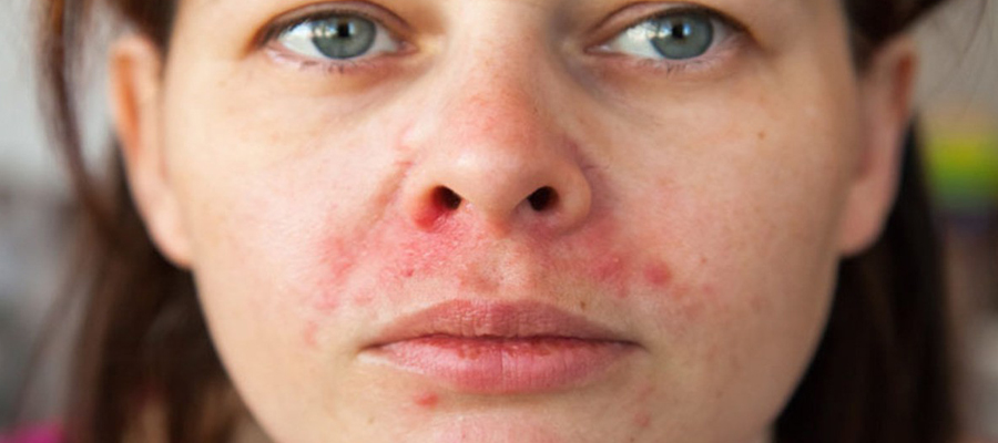 psoriasis du visage